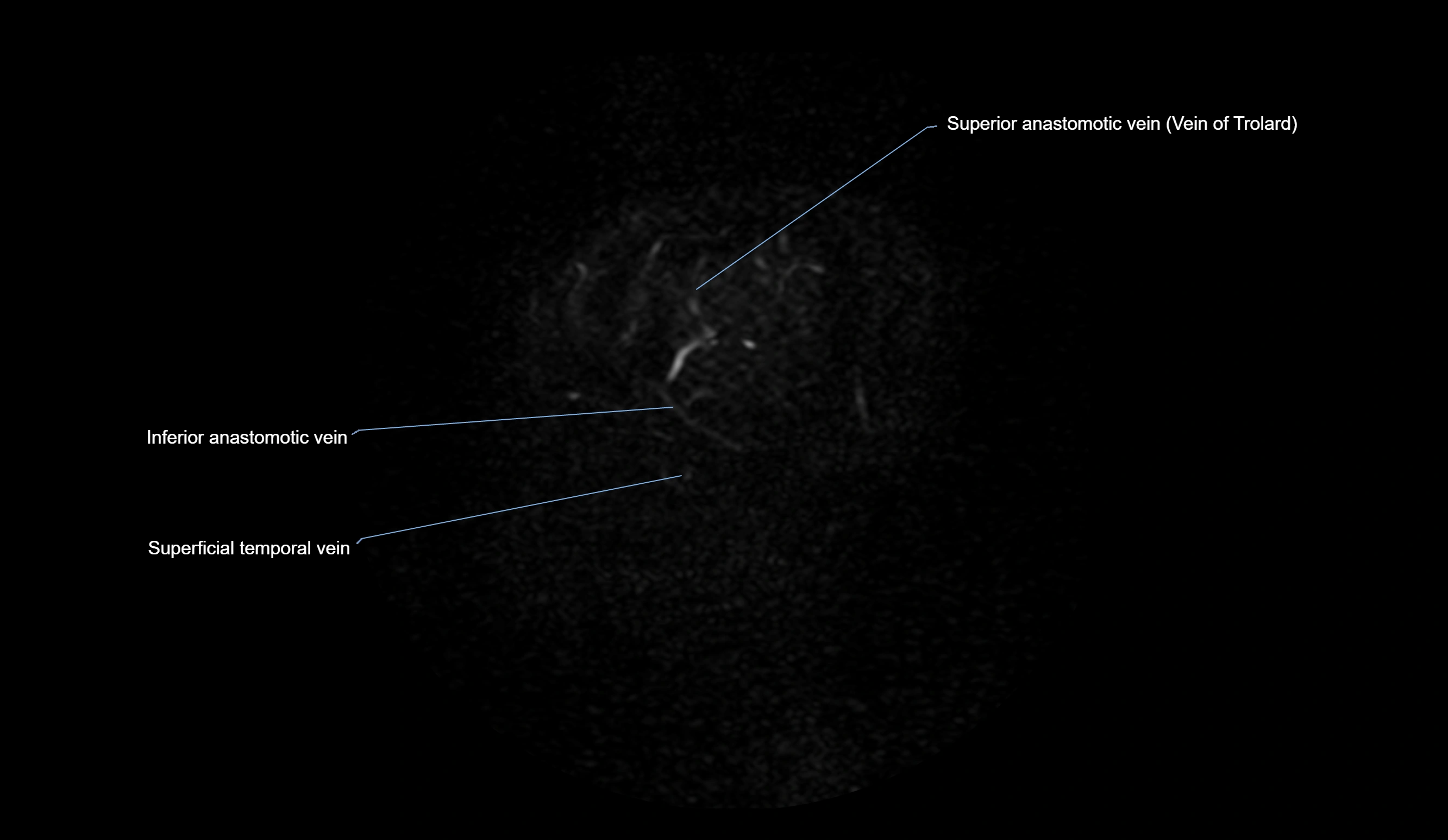 MRV brain sagittal anatomy 3T MRI labelledimages -00075.webp